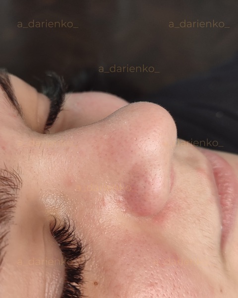 Після процедури — косметолог Ангеліна Дарієнко Миколаїв