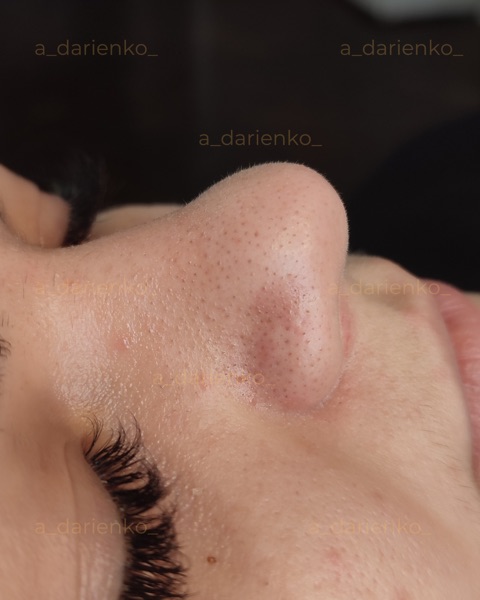 До процедури — косметолог Ангеліна Дарієнко Миколаїв