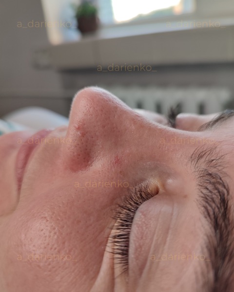 Після процедури — косметолог Миколаїв