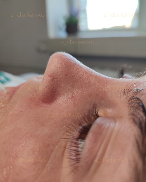 До процедури — косметолог Миколаїв