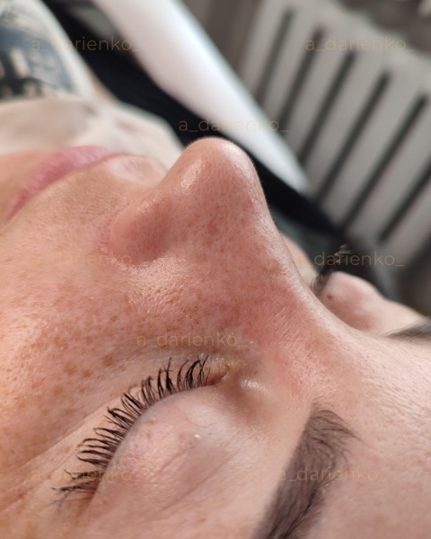 Після процедури — косметолог Миколаїв