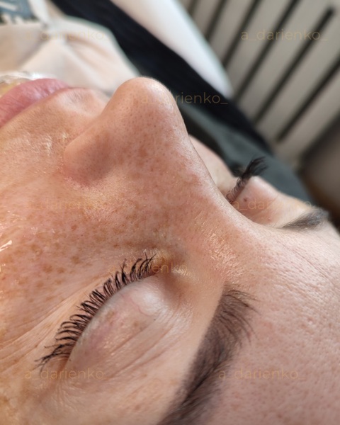 До процедури — косметолог Миколаїв