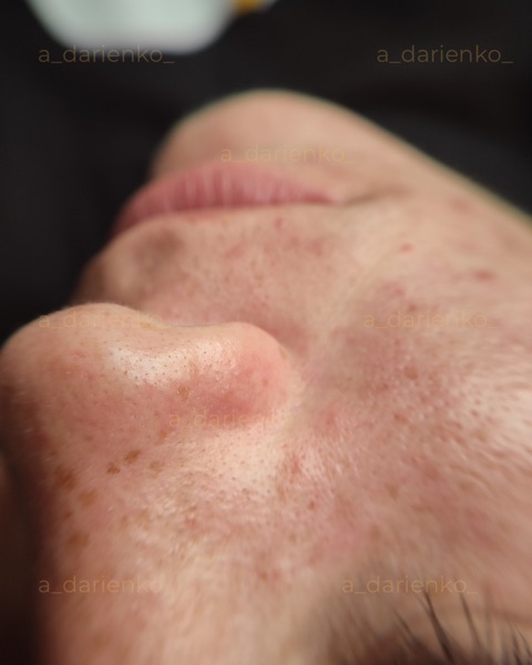 Після процедури — косметолог Миколаїв