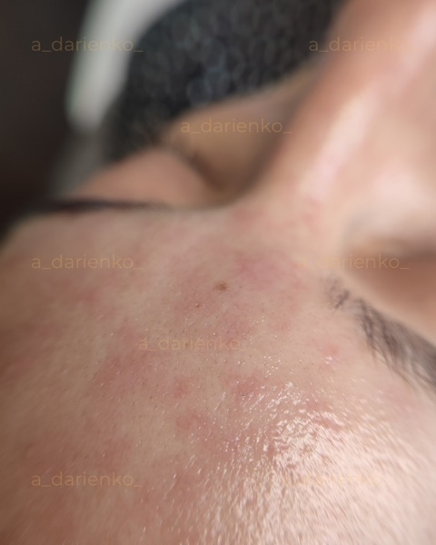 Після процедури — косметолог Миколаїв