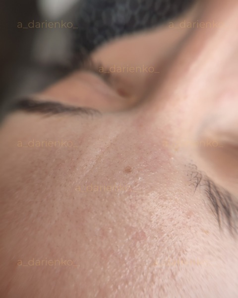 До процедури — косметолог Миколаїв