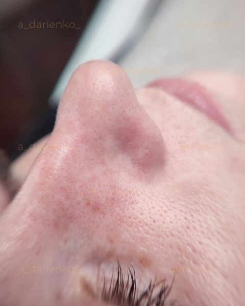 Після процедури — косметолог Миколаїв