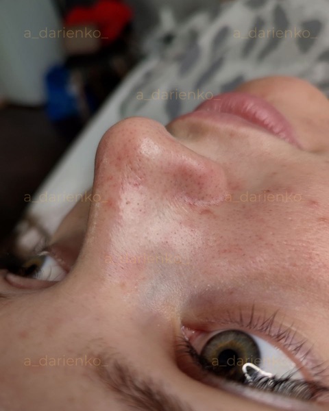 Після процедури — косметолог Миколаїв