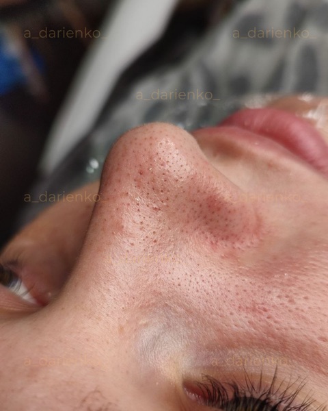 До процедури — косметолог Миколаїв