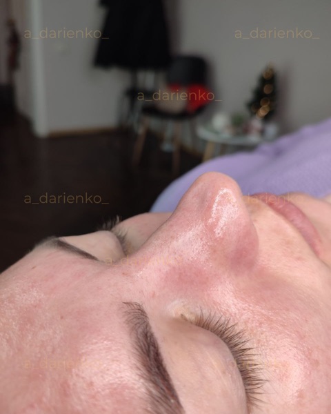 Після процедури — косметолог Миколаїв