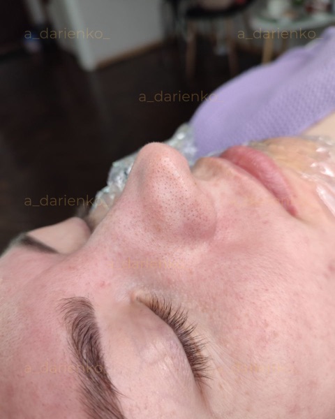 До процедури — косметолог Миколаїв